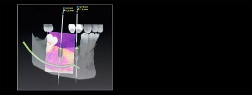 Implantología 3D